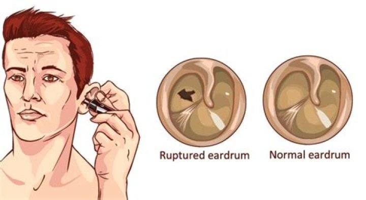 Are ruptured eardrum permanent?
