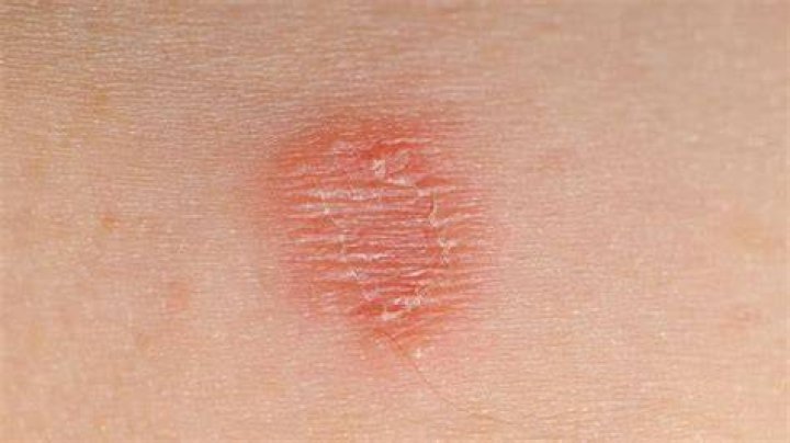 Can ringworm be oval shape?