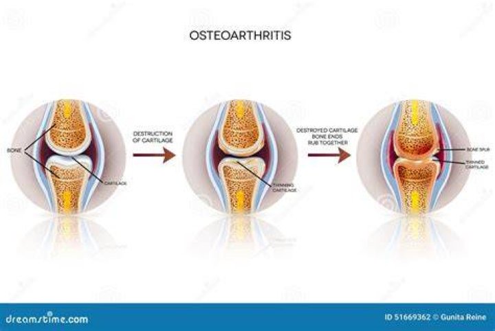 What does osteoarthritic changes mean?