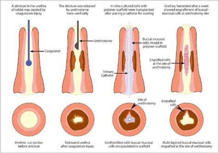 Why do urethral strictures return?